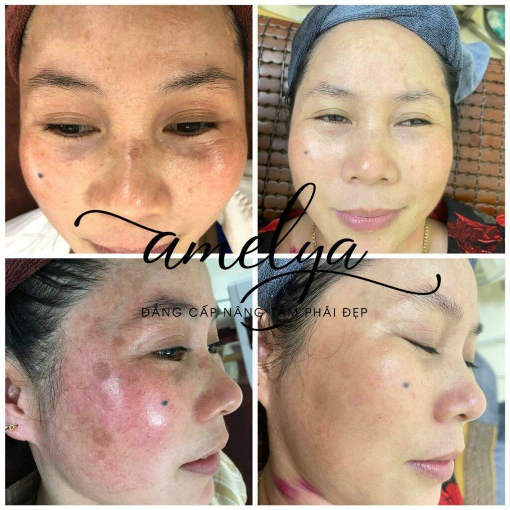 Vết nám sạm, tàn nhang mờ rõ rệt sau khi sử dụng mỹ phẩm trị nám Amelya