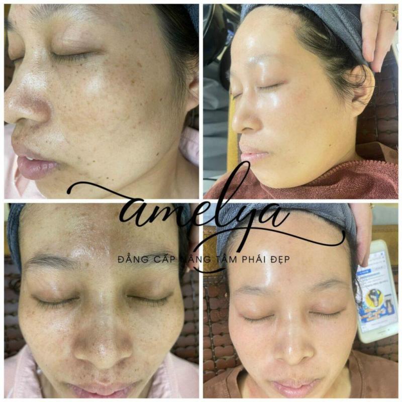 Những vết nám sạm, tàn nhang mờ rõ rệt sau khi sử dụng sản phẩm trị nám Amelya